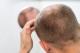 Нов третман против опаѓање на косата предизвикано од алопеција
