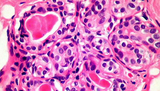 Научници од Универзитетот во Кардиф: Лекот за ракот најверојатно е во човечкото тело