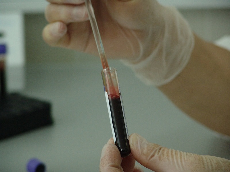 Нов тест на крв поддржан од вештачка интелигенција ветува лесен скрининг за над 50 вида рак