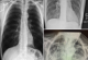 Како изгледаат бели дробови на пациент со Ковид-19 во споредба со бели дробови на пушач